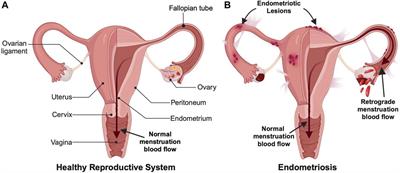 Nanotechnologies for the detection and treatment of endometriosis